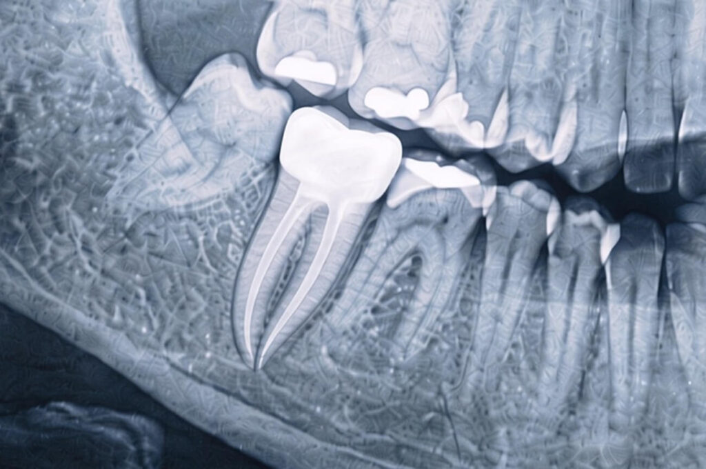After img endodoncie xray