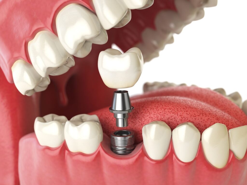 Cown installation implants
