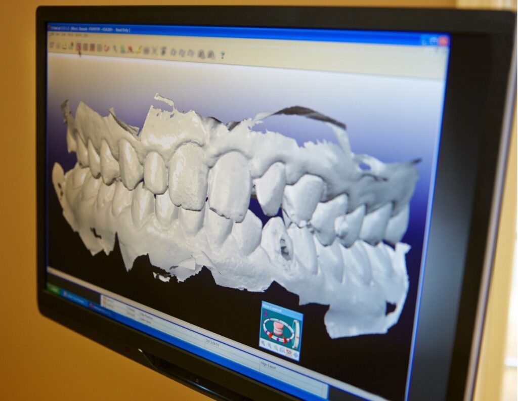 Digital scan implants