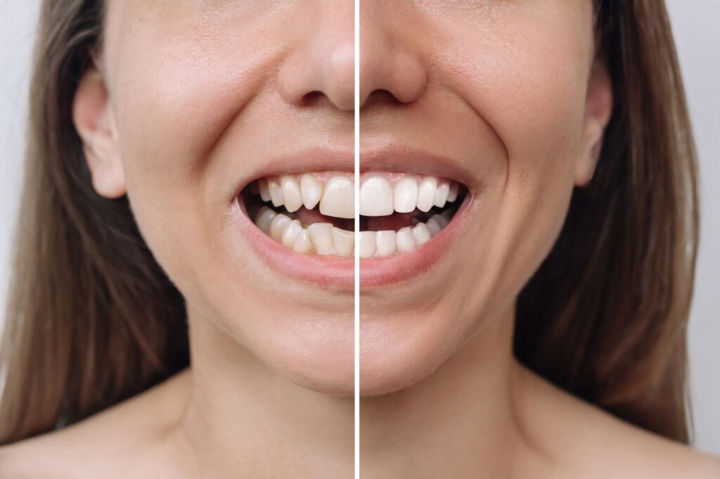 Teeth straightening